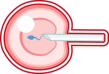 In Vitro fertilization IVF vector infographic and infertility treatment scheme with red line artificial insemination, embryo culture and cryopreservation. Medical procedure for pregnancy