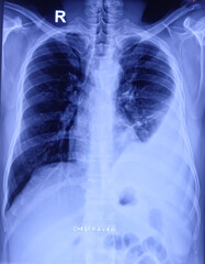 Film x-ray chest PA or CXR (PA view).
