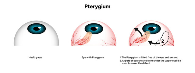 Pterygium eye disease lifted free of the eye and excised optometry appointment 