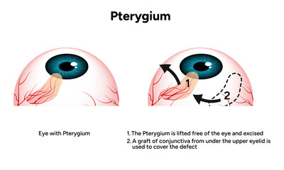 Pterygium eye disease lifted free of the eye and excised optometry appointment 