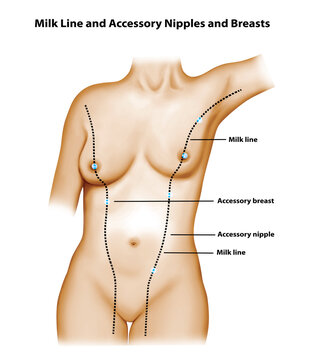 Milk Line and Accessory Nipples and Breasts 