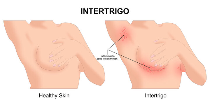 Intertrigo skin fold dermatitis illustration
