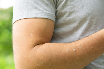 Fototapeta premium dry sunburn peeling skin on a man's arm 