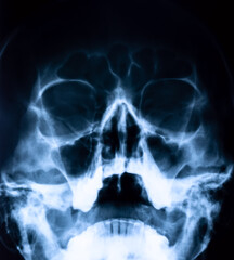 Medical concept. X-ray of nasal sinuses and head