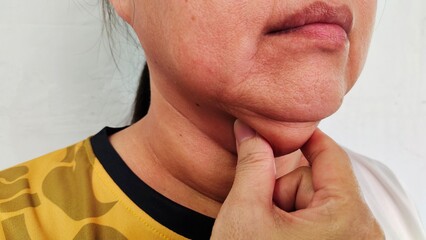 Fototapeta premium portrait the fingers squeezing the flabbiness adipose sagging skin under the chin, neck wattle and cellulite under the neck, Flabby and scar on the body of the woman, health care and beauty concept.
