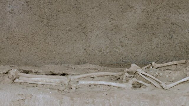 Trepanned skeleton with surgery intervention skull burr hole. Human skull with trepanation.