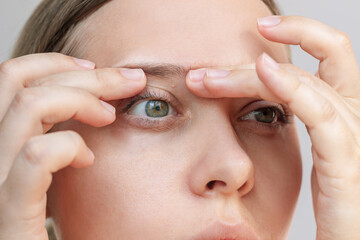 Milia (Milium) on the eyelid of a young woman. The girl showing white cysts on her skin with her...
