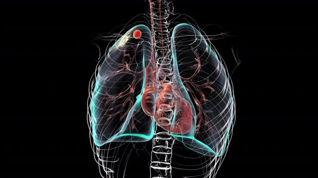 Lungs affected by secondary tuberculosis, 3D animation.