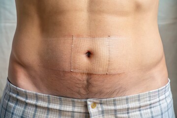 Close-up of a healed abdominal area showing a faint ostomy scar, a testament to successful temporary surgery and recovery, with a subtle grid pattern on the skin.