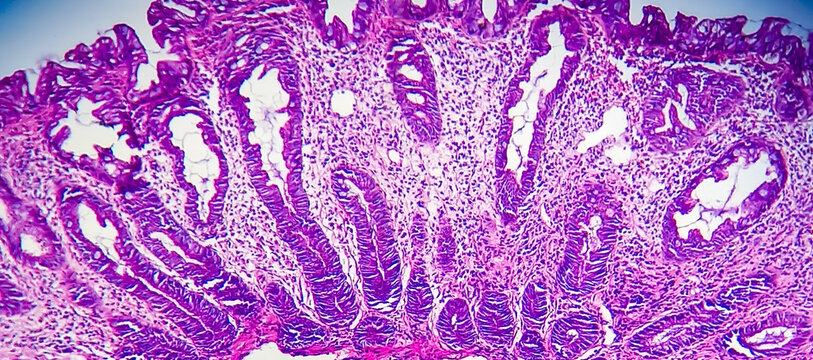 Tubular adenoma with low-grade dysplasia. Microscopic image of an adenoma. Colonoscopy can prevent cancer by removing adenomas before they transform into cancer.