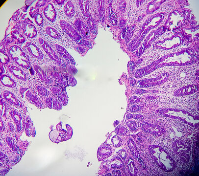 Tubular adenoma with low-grade dysplasia. Microscopic image of an adenoma. Colonoscopy can prevent cancer by removing adenomas before they transform into cancer.