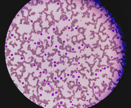 Leukemia. blood cells, blast cells, and immature leukocytic cells in chronic lymphocytic leukemia, and prolymphocytic leukemia. Analyze by microscope.