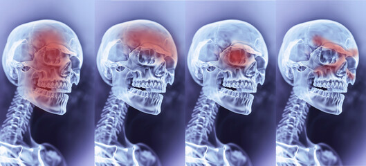 Different Types Of Headache, Migraine. Skull, Skeleton With Red Mark Of Painful Zones. Sinus, Cluster, And Tension. Medical Condition. AI Generated Horizontal. Healthcare, Medicine.