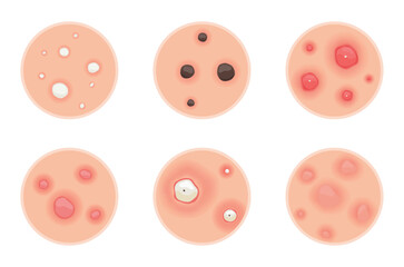 Understanding Type of Acne A Comprehensive Visual Guide for Everyone