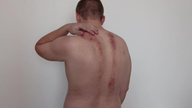 Redness and irritation on the skin of a man s back after a massage. Pimples and red spots with bruises on the skin, close-up, erythema