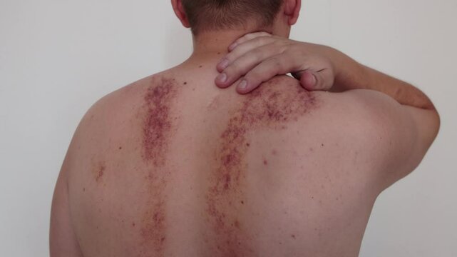Redness and irritation on the skin of a man s back after a massage. Pimples and red spots with bruises on the skin, close-up, erythema