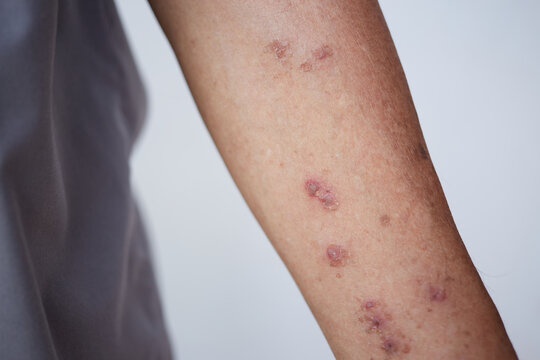 Dermatitis on skin, Skin decease becomes red, swollen, and sore, sometimes with small blisters