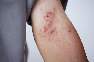 Fototapeta premium Dermatitis on skin, Skin decease becomes red, swollen, and sore, sometimes with small blisters