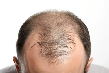 Fototapeta premium Close-up of mature man head on white background. Balding hair loss concept. Male adult with receding hairline, thinning hair, and scalp showing. Hair follicles not visible.