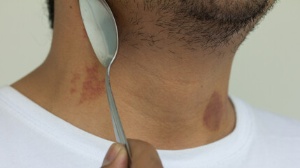 Picture of spoon healing a hickey on a person's neck.