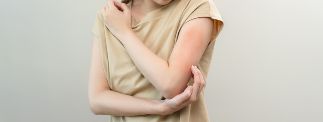 young woman scratching on her arm and has a red rash irritation on her skin from dust intolerance.