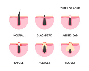Acne types, skin pimples, face comedones. Cosmetology poster problems acne.