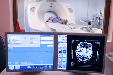 Medical imaging in a hospital, showcasing a patient undergoing a CT scan with diagnostic monitors on display