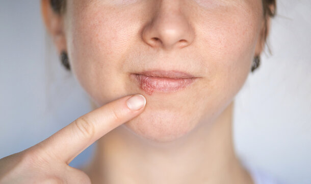 Skin care and lip health awareness with close up focus on cold sore and finger pointing for dermatology education