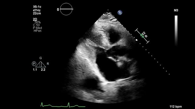 echocardiogram of a patient with AFIB