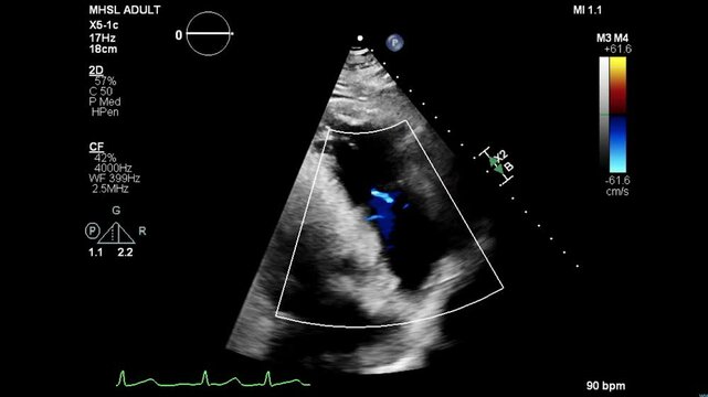 color echocardiogram of patient with AFIB