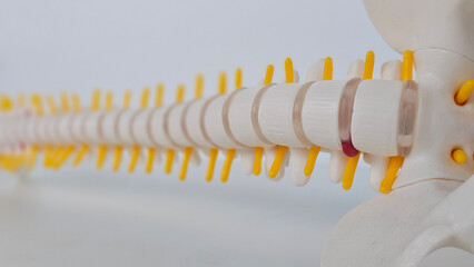 Lumbar spine displaced herniated disc fragment, spinal nerve and bone