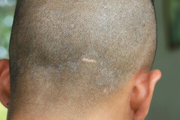 Naklejka premium Scars on the skin of the head