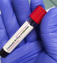 Blood sample for Hand foot and mouth disease (HFMD) test. It is a highly contagious infection. It's...