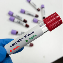 Blood sample for Hand foot and mouth disease (HFMD) test. It is a highly contagious infection. It's...