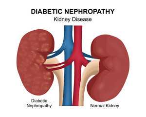 Diabetic Nephropathy Kidney Disease Illustration