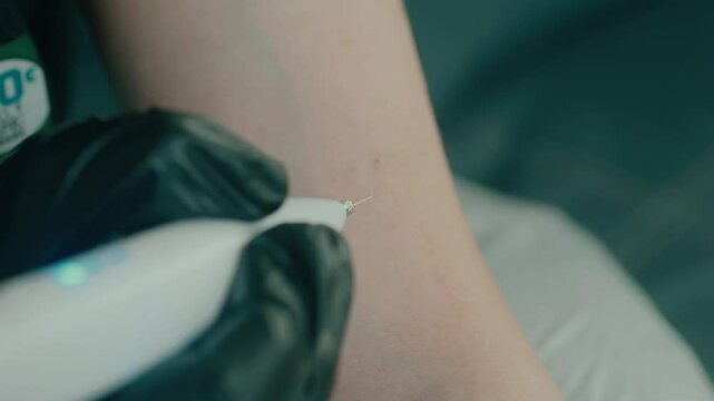 Cosmetologist's hands in black gloves using Laser Plasma Pen on patient's skin.