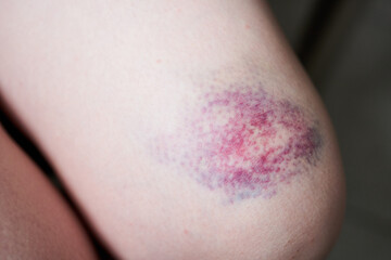 Fototapeta premium Close-up of bruise on the skin of a young woman