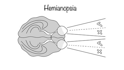 Hemianopsia