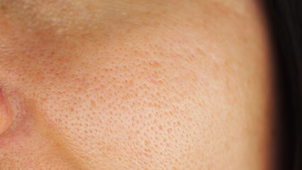 Fototapeta premium oily skin with cuperose. skin texture with enlarged pores.