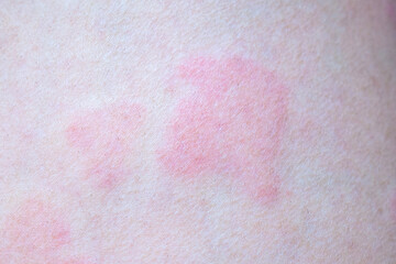 Skin allergy rash dermatitis texture close up