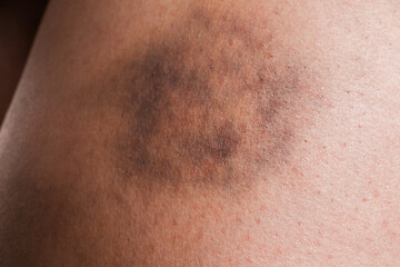 Closeup view of woman with bruise on leg