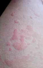 Closeup of skin affected by urticaria, showing red, raised welts and irritation