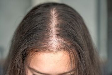Close-up view of the head with traces of blood from injections after mesotherapy, treatment of...