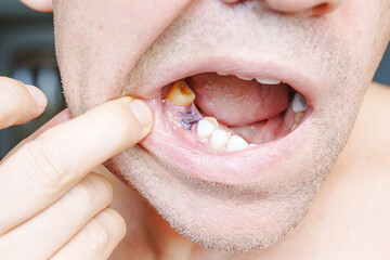 close-up. man showing a sutured socket in the oral cavity after tooth extraction. the work of a...