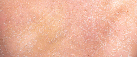 Sunburn, close-up of human skin. Flaky skin from allergies, peeling or eczema. Dry skin in need of treatment and hydration.