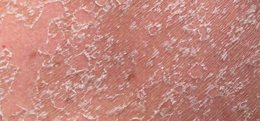 Sunburn, close-up of human skin. Flaky skin from allergies, peeling or eczema. Dry skin in need of...