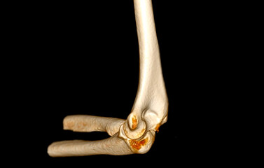 A 3D CT scan of the elbow joint showing normal bone structure and alignment of the humerus, ulna, and radius, with no signs of injury or abnormalities present.