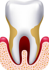 Periodontitis drawing. Dental clinic treatment. Tooth disease