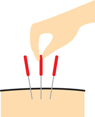 Hand taking Acupuncture needles insert into the body.