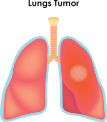 Healthy Lung Anatomy Trachea Superior Lobe Bronchi Tumor Inferior Lobe Middle Lobe Science Vector Illustration